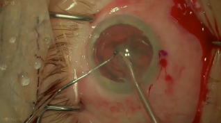 3D Digital Visualization FLACS in Heredofamilial Vitreoretinopathy Spherophakia