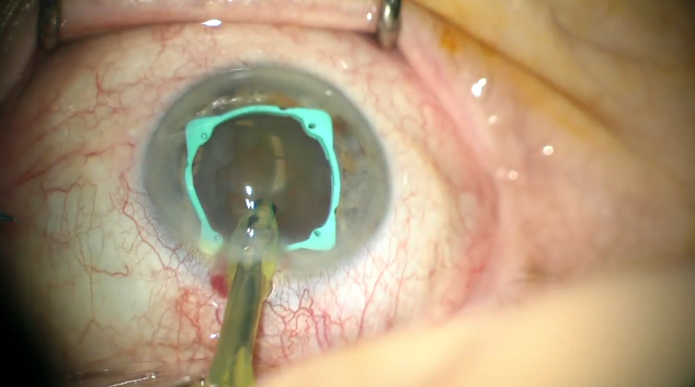 Cataract Surgery in an Eye With a History of Trauma and Floppy Eyelid ...