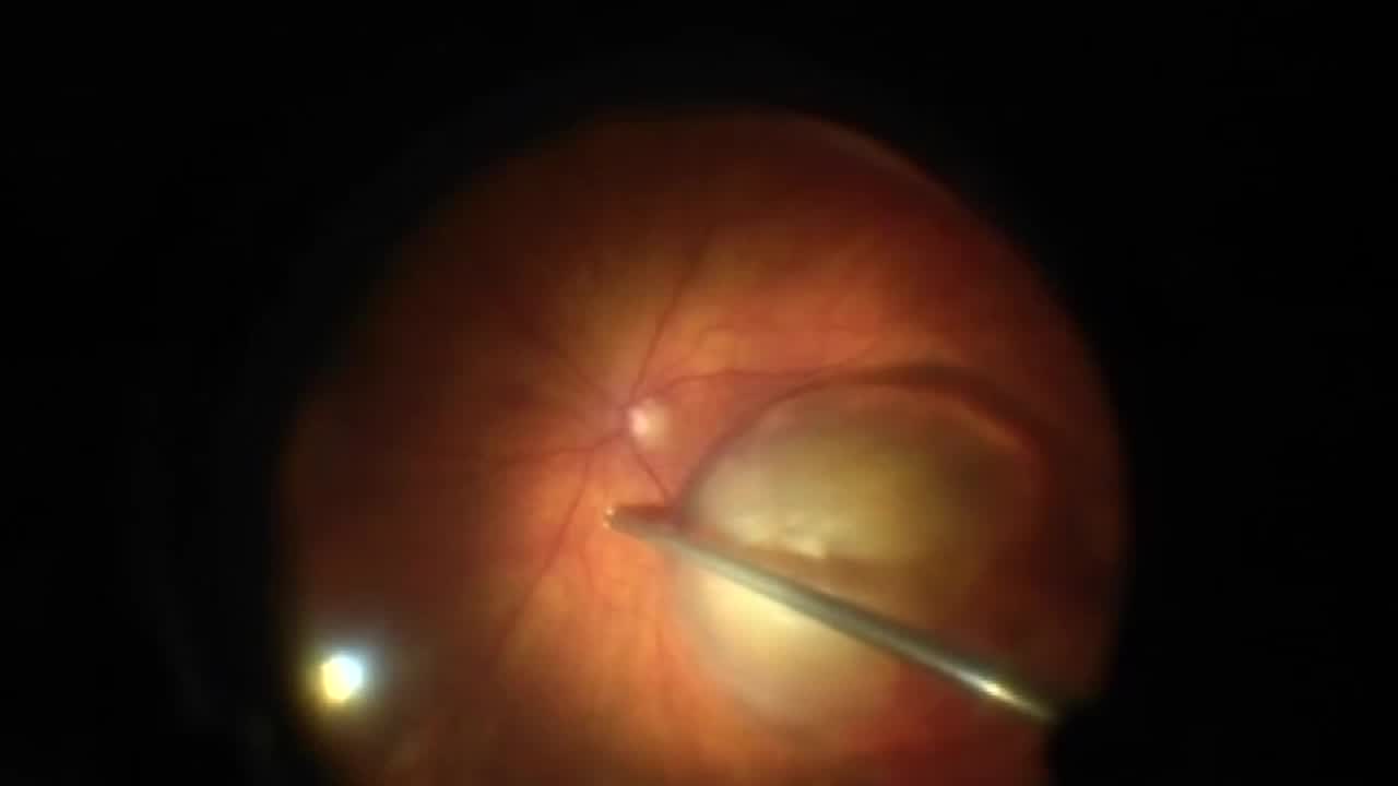 Tips for Dropped Nuclei