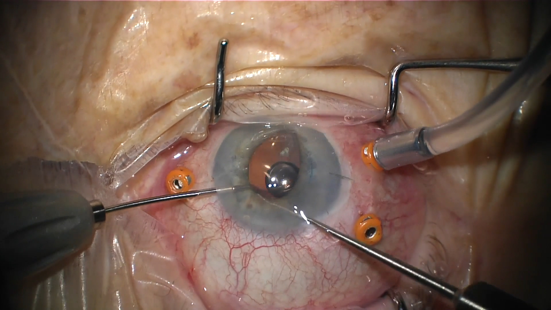 Retained Lens Fragment After Cataract Surgery