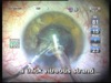 Very Long Standing Dense Post Rubella Cataract