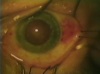 Astigmatic Reduction: On Axis