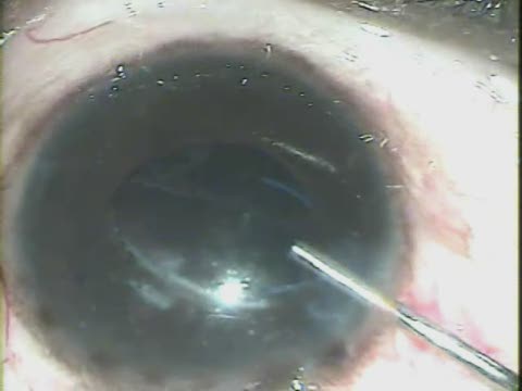 Old Traumatic Cataract