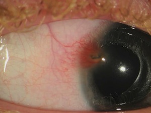 Corneal Foreign Body Extraction