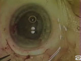 The Sheets Glide for Posterior Capsule Tear