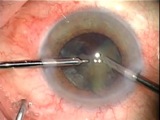 Routine Cataract Surgery with Burkhard Dick, MD