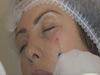 Hollow Eye Ring Management with Hyalurostructure