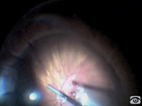 Hypotony Following PFO Injection
