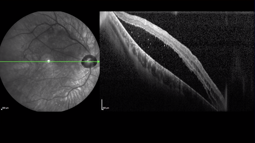 Optic Nerve Pit - Eyetube