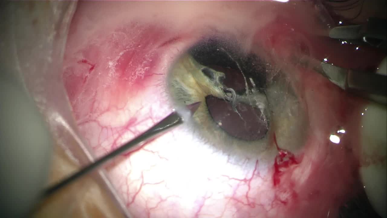 Traumatic Iridodialysis and Cyclodialysis Repair in Phakic Child