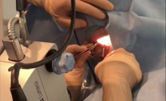 Patient Positioning Problems: Second Eye