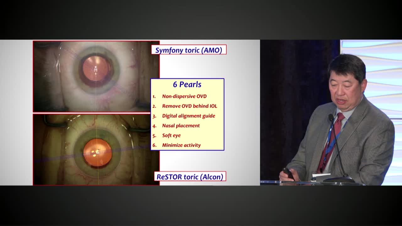 Toric IOL Pearls: Avoiding Rotation
