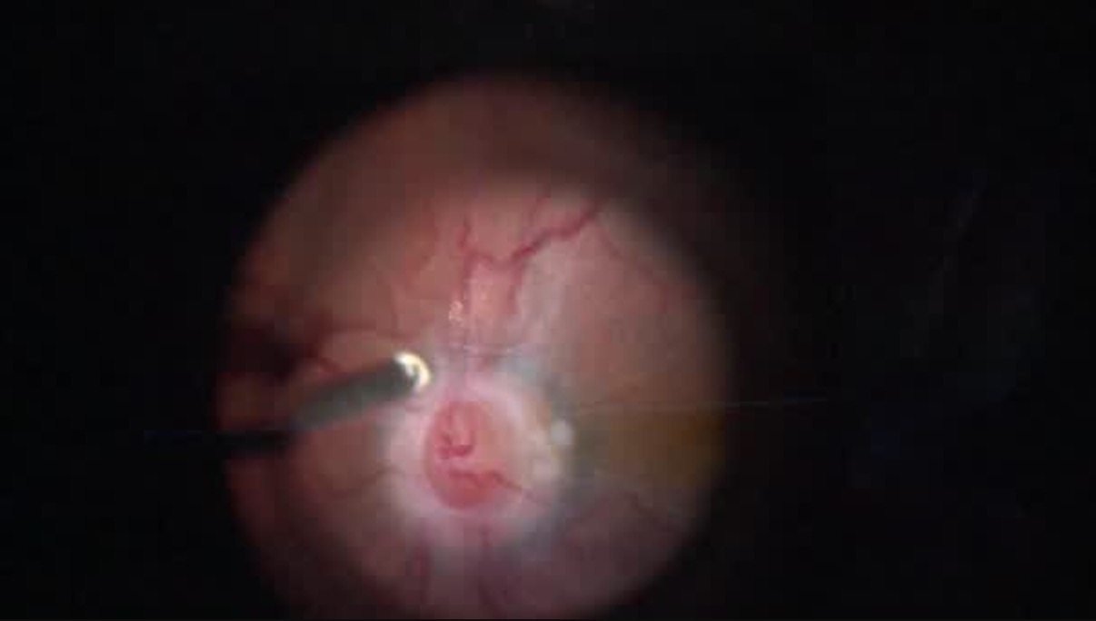 Intraoperative OCT Shadow Technique Demonstrated [FLOREtina Live Surgery]