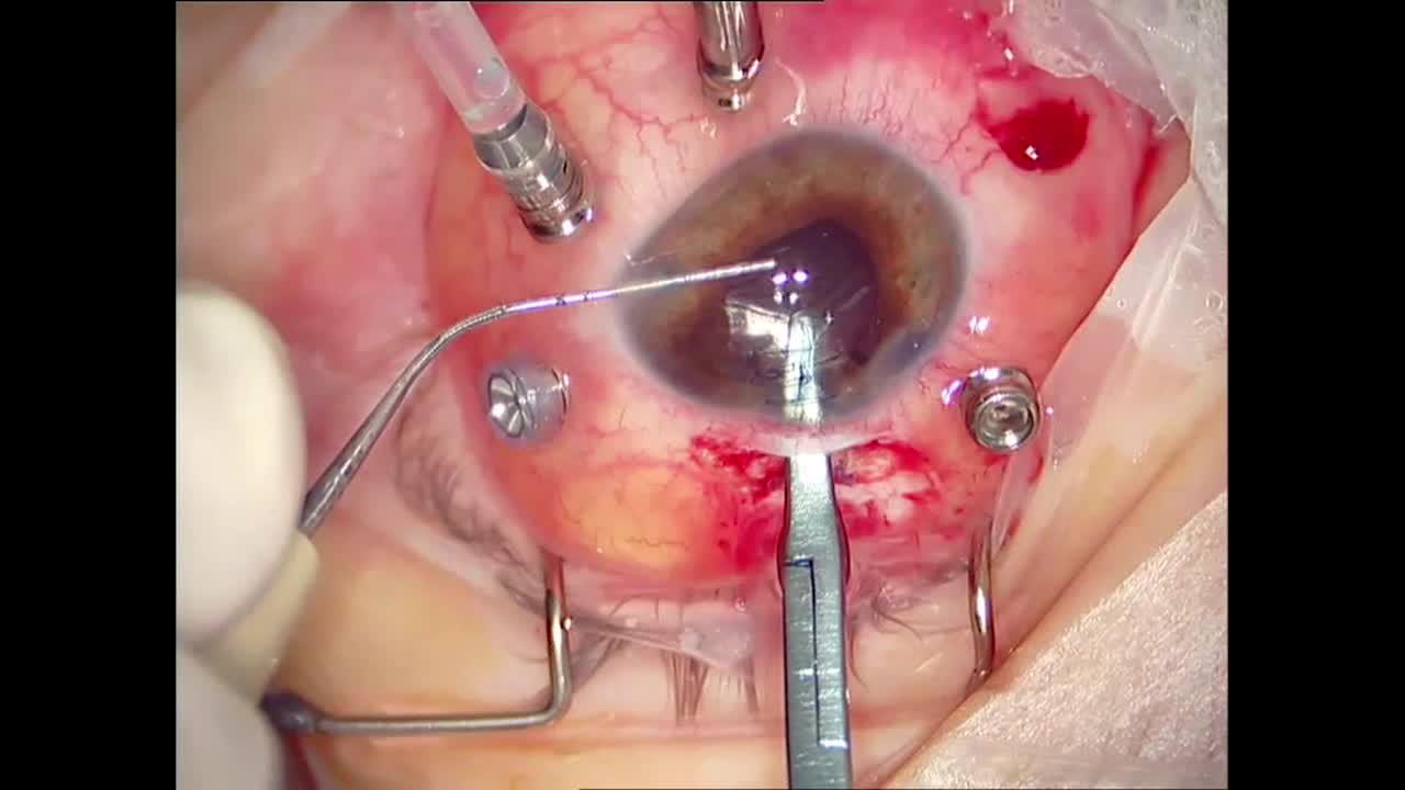 Management of Perforating Eye Injury