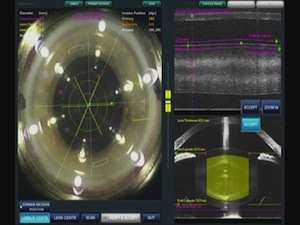  Image-Guided Posterior Capsule Detection