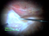 Combined Diabetic Traction Retinal Detachment and Rhegmatogenous Retinal Detachment