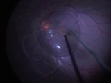 Dislocated Phakic Intraocular Lens