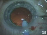 Multifocal IOLs