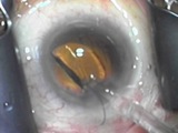 Inserting an IOL with the iSert