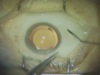 20G Trochars