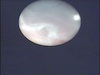 23-gauge Endoscope to Visualize Retinal Detachment With Corneal Decompensation - Eyetube