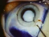 Pediatric cataract surgery