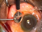 Wound Construction in MIVS