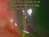 Acute Bubble Trouble - Glaucoma Post DSEK