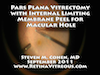 Vitrectomy with Internal Limiting Membrane Peel for Idiopathic Macular Hole