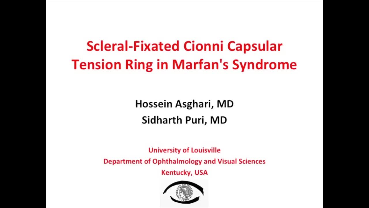 Scleral-Fixated Cionni Capsular Tension Ring in Marfan Syndrome