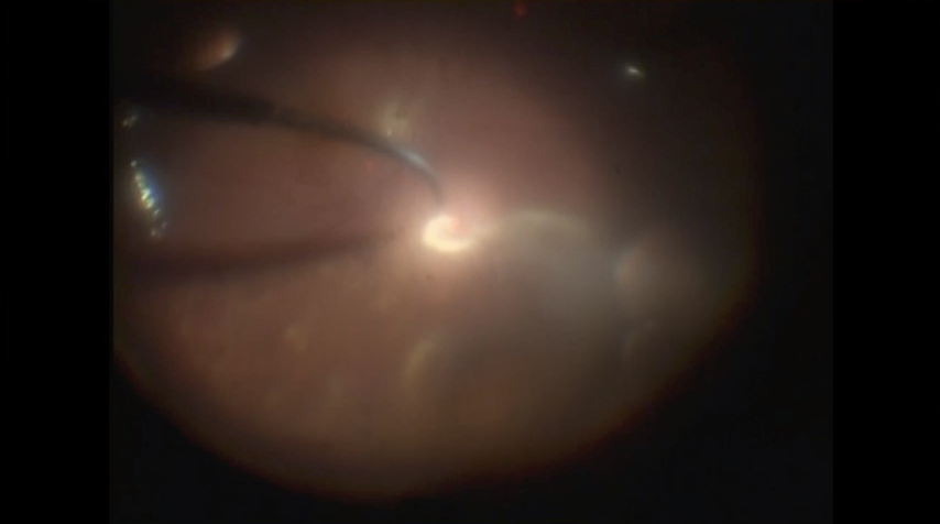 Retinal Detachment with PVR