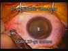 27-Gauge Diabetic Retinopathy