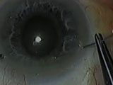 Modified McCannel Suture Technique for Superior Iris