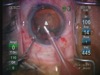 The Sandwich Phaco Technique