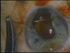 Coloboma Closure 