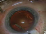 Anterior Capsulectomy Techniques and Complications