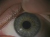 Unilateral Myopia