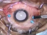 25-g Vitreous Removal Using Triesence Visualization
