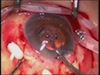 IOL and Capsule Tension Ring Dislocation in Glaucoma Case