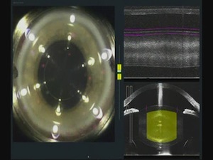 SoftFit™ Patient Interface