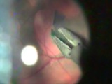 ILM Peeling Using the 12-3044 Lucke ILM Universal Forceps