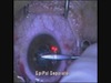 Flexivue Micro-Lens Implantation