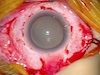 Scleral Buckle for Rhegmatogenous Retinal Detachment