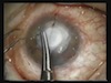 Human Fibrin Glue in Multilayered Amniotic Membrane Transplantation