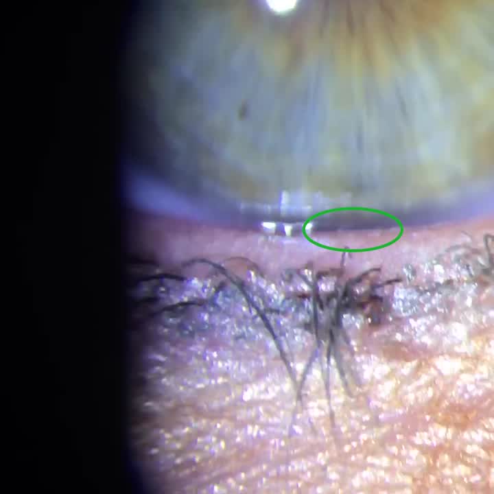 TrueTear Stimulating Meibomian Gland Expression