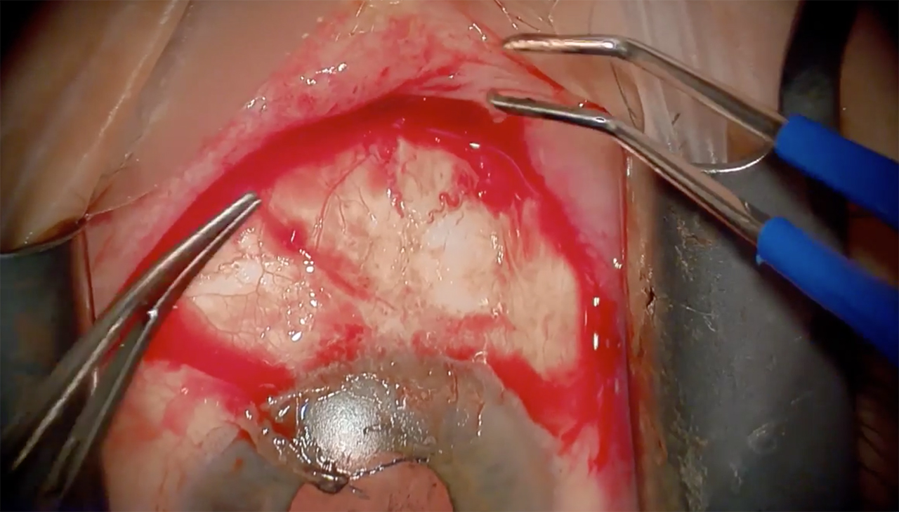Primary Pterygium Surgery with AmnioGraft (Neel Desai, MD)