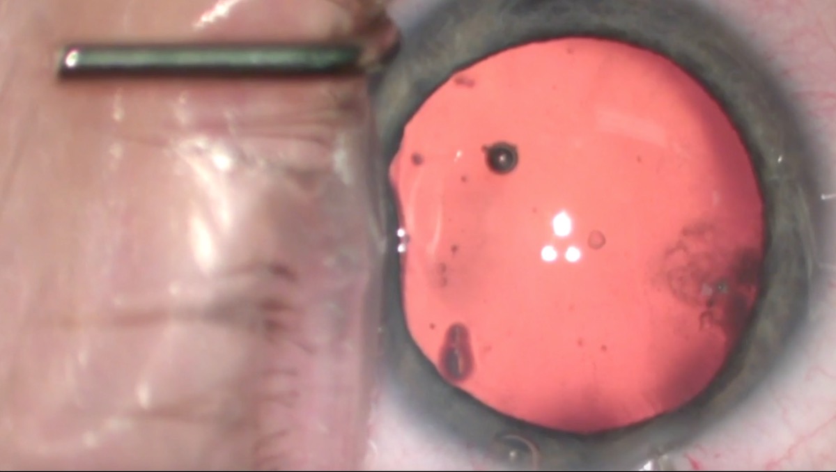 miLOOP Training: Temporal Two Handed Technique on Moderately Dense Cataract Nucleus in a Combination Retina Case