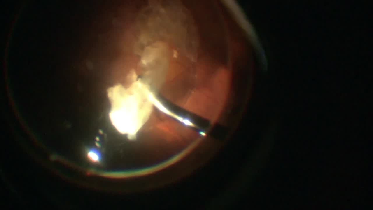 Traumatic Lens Luxation