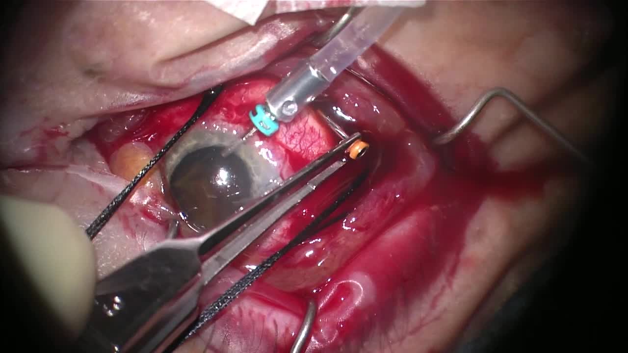 Technique for Draining a Choroidal Hemorrhage