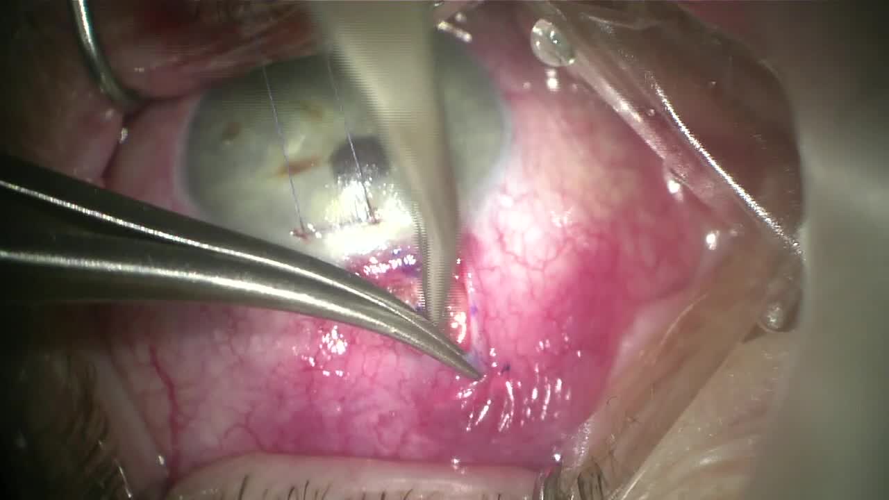 Xen Implantation With Subconjunctival Placement of Dextenza